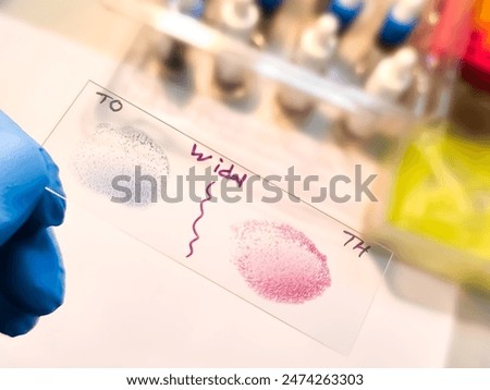 Widal test by agglutination method showing positive TO and TH result, Typhoid and Paratyphoid fever, salmonella
