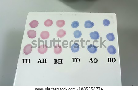 Widal test isolated on a testing plate, diagnosis of typhoid fever. Closeup