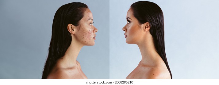 Wide Angle Shot Of Woman Showing The Power Of Makeup In Hiding Skin Imperfections. Before And After Shot Of Woman Suffering From Acne Problem.