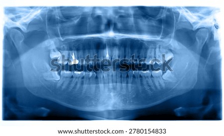 Wide panoramic x-ray image of teeth and jaw with visible dental work for diagnostic and educational use.