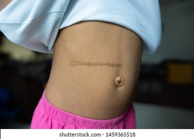 Wilm's Tumour Kidney Removal Scar 2 Years Later