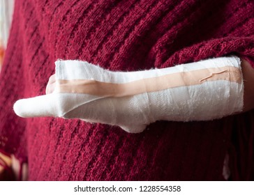 Winter Sports Injury At The Hand