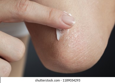 Winterizing Dry Itchy Skin On The Elbow Area