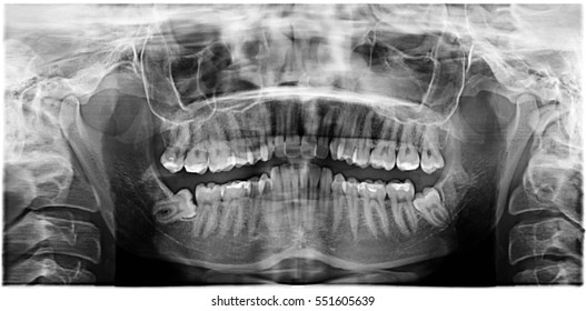 Wisdom tooth roentgen picture, eighth tooth grows crooked, patient 28 years