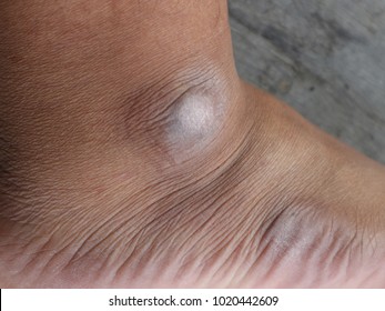Withered white ankle and ankles.
