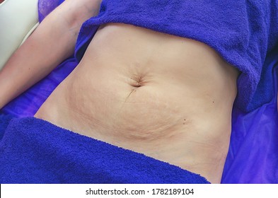 Woman abdomen after childbirth, visible stretch marks, age skin changes. Lies in beauty salon, procedures. Concept for medicine and cosmetology, skin care