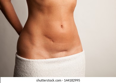 Woman with abdominal scars