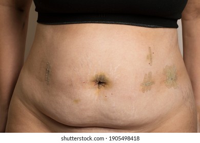 Woman abdominal scars after laparoscopic bariatric surgery, weight loss concept. Woman belly gastric surgery, close up