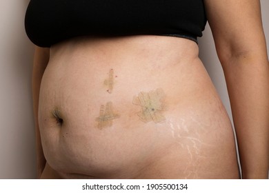 Woman abdominal scars after laparoscopic bariatric surgery, wheight loss concept. Bariatric weight loss surgery