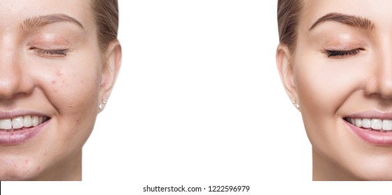 Woman with acne before and after treatment and make-up. Copy space. Skin care concepts - Shutterstock ID 1222596979