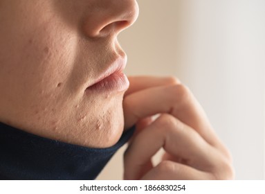 Woman With Acne And Irritation From Wearing A Mask. 