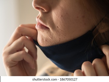 Woman With Acne And Irritation From Wearing A Mask. 