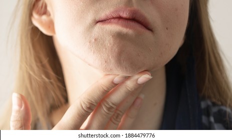 Woman With Acne And Irritation From Wearing A Mask. 