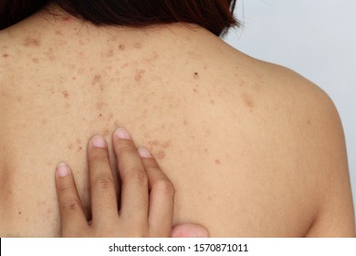 Woman With Acne On The Back