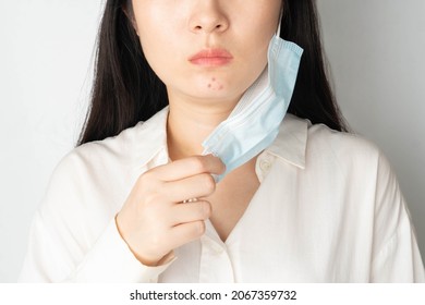 Woman With Acne On Her Chin That Caused By Wearing Medical Face Mask, Result In Skin Including Redness, Bumpiness, And Irritation. Skin Sensitive Or Allergic To The Material Of Face Covering.