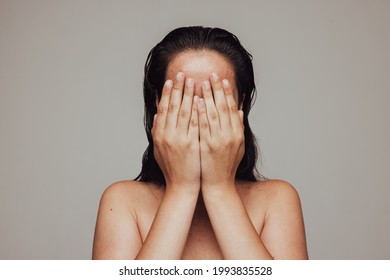 Woman with acne problem hiding her face with her hands. Woman feeling insecure due to skin imperfections.