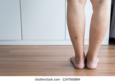 Woman With Acne Scars Black Color With Problematic Problem Skin On Leg Close Up