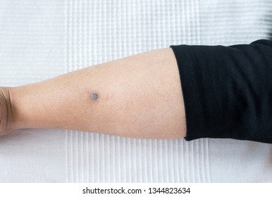 Woman With Acne Scars Black Color With Problematic Problem Skin On Leg Close Up