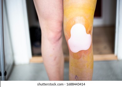 A Woman After Knee Arthroscopy For Partial Meniscectomy And Plica Removal On Her Left Knee Surgery Walking On Crutches. She Has A Butterfly Tape On Her Knee And Iodine All Over Left Leg. 