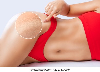 A woman after weight loss shows stretch marks on the skin of her legs and the outer and inner side of the thighs. Treatment of skin stretch marks in the clinic.