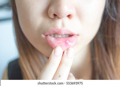 Woman with aphthae on lip. - Shutterstock ID 553693975