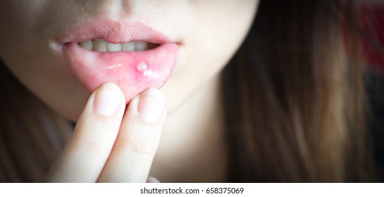 Woman with aphthae on lip. - Shutterstock ID 658375069