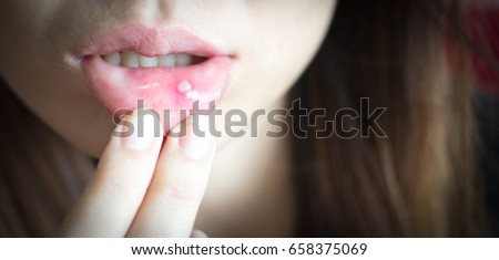 Woman with aphthae on lip.