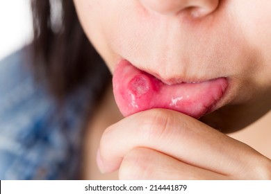 Woman With Aphthous Stomatitis 