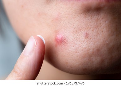 Woman Apply Cream On The Acne.