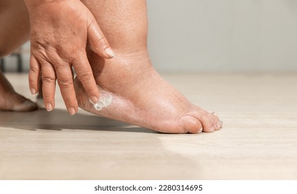 Woman apply moisture lotion on edema (swelling) leg after cancer treatment. Broken heel. - Powered by Shutterstock