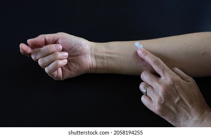 A Woman Applying Cream To Heal The First Degree - Heat Burn Wound  From The Iron On Her Arm ,dark Background