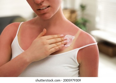 Woman Applying Cream On Sunburn At Home, Closeup