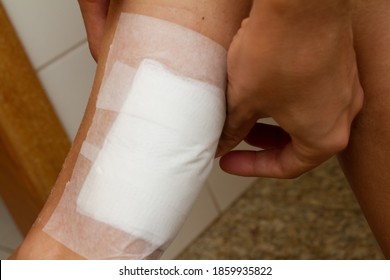 A woman applying a gauze bandage to a second degree burn on the back of her leg