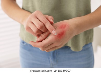 Woman applying healing cream onto burned hand indoors, closeup