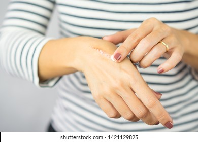A woman applying scars removal cream to heal the first degree - heat burn wound on her hand. Healing, Removal, treatment, Hot oil burn, Vitamin E, Scars care, Skin care products, Medical cream, Repair