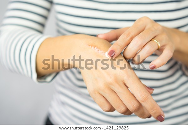 A woman applying scars removal cream to heal the\
first degree - heat burn wound on her hand. Healing, Removal,\
treatment, Hot oil burn, Vitamin E, Scars care, Skin care products,\
Medical cream, Repair