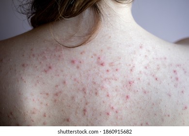 Woman Back With Acne, Red Spots, Skin Disease