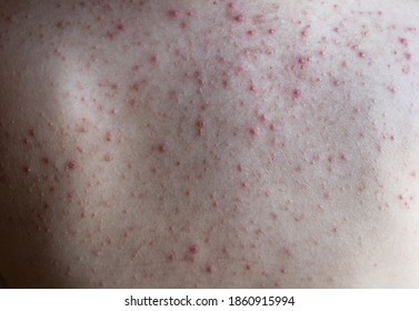 Woman Back With Acne, Red Spots, Skin Disease