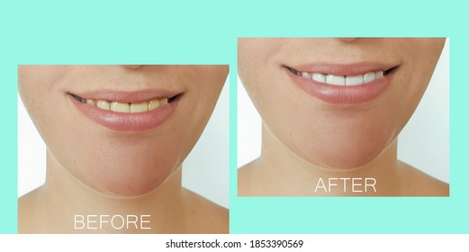 woman beautiful smile teeth before and after whitening