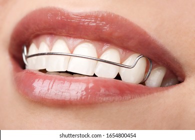 woman beautiful teeth with retainer orthodontic correction - Shutterstock ID 1654800454