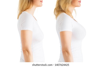 Woman Before And After Breast Augmentation Plastic Surgery