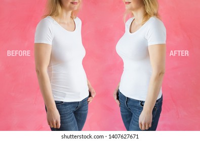 Woman Before And After Breast Enhancement Plastic Surgery