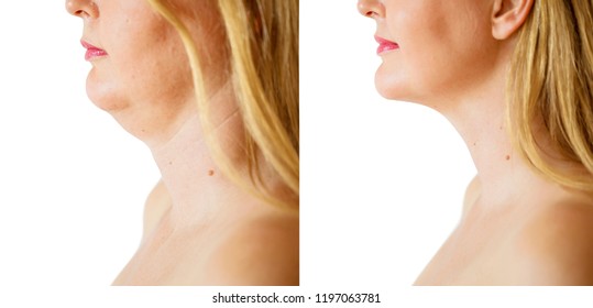 Woman Before And After Chin Fat Correction Procedure