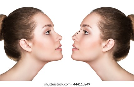 Woman Before And After Cosmetic Nose Surgery