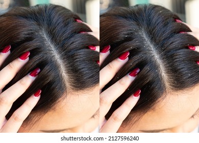 Woman Before And After Dandruff Treatment. Problem Health Care Concept.