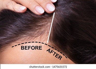 Woman Before And After Hair Loss Treatment