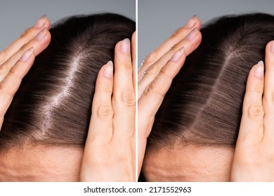 Woman Before And After Hair Loss Treatment