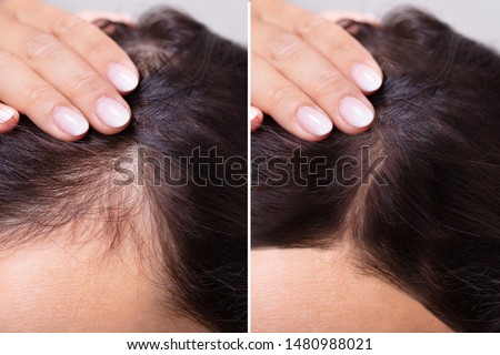 Woman Before And After Hair Loss Treatment