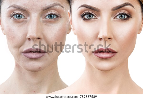 Woman Before After Rejuvenation Plastic Surgery Stock Photo 789867589 ...