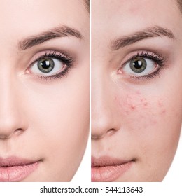 Woman before and after treatment